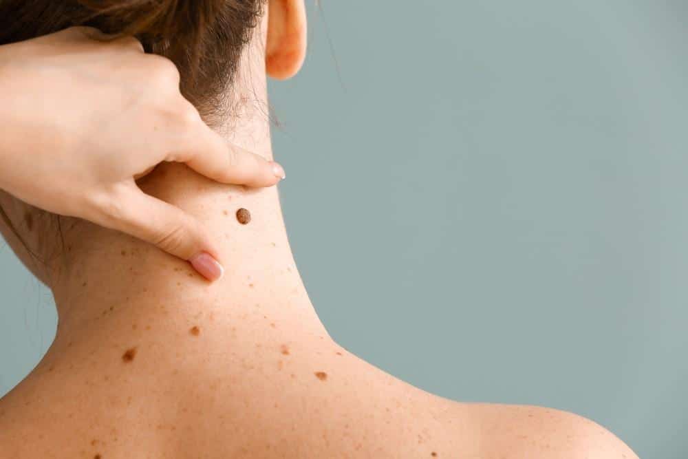 Are Moles a Health Concern?