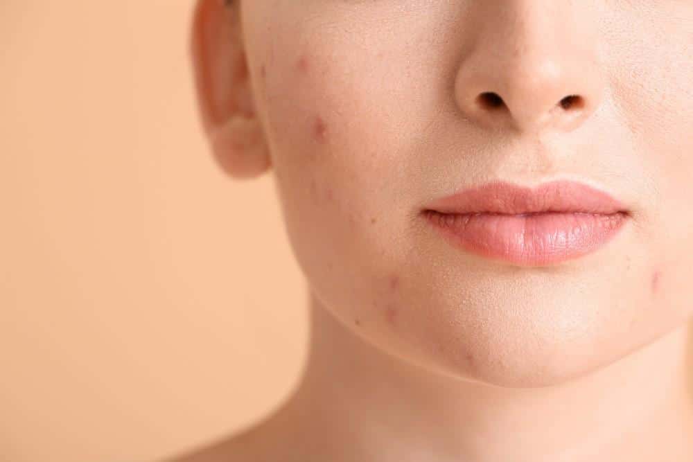 What Causes Adult Acne and How Is It Treated?