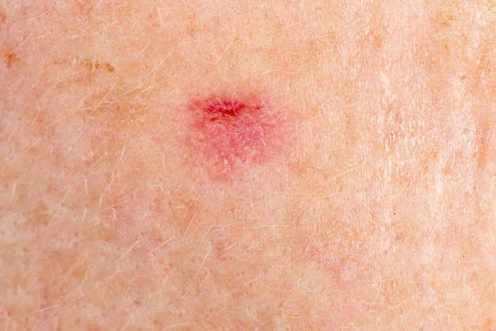 How Does Mohs Surgery Work?