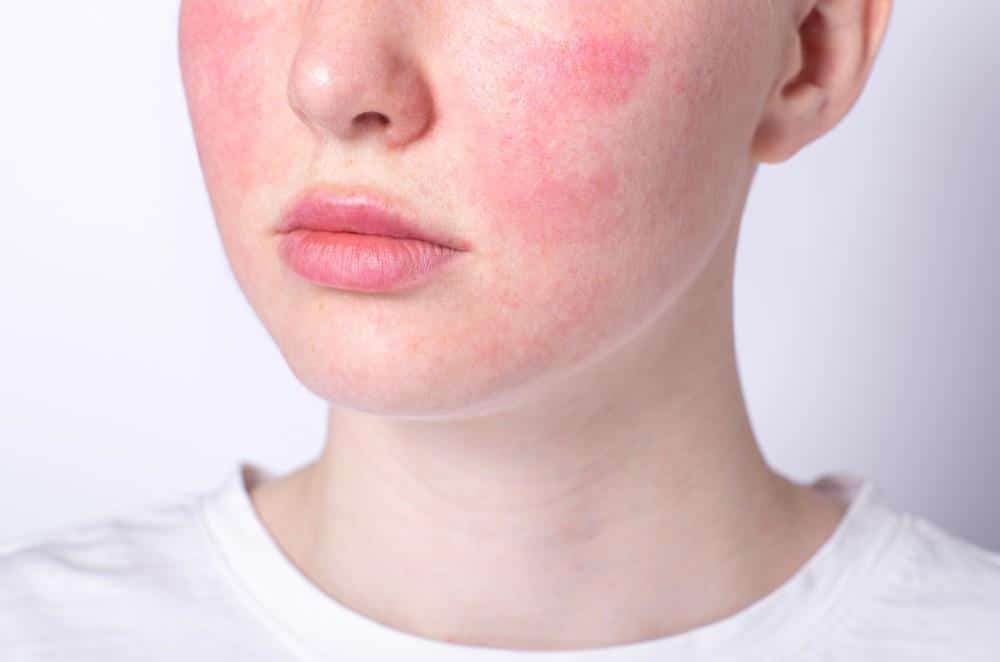 Seasonal Rosacea Management: How to Minimize Flares and Treat the Redness as You Enjoy the Summer