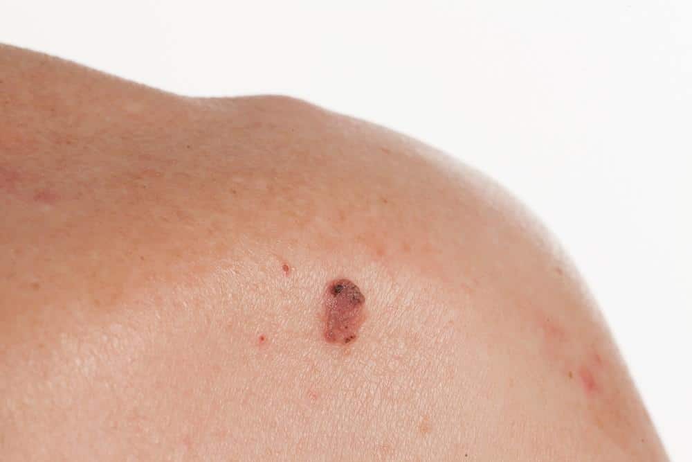 Does a Discolored Mole Always Mean Melanoma?
