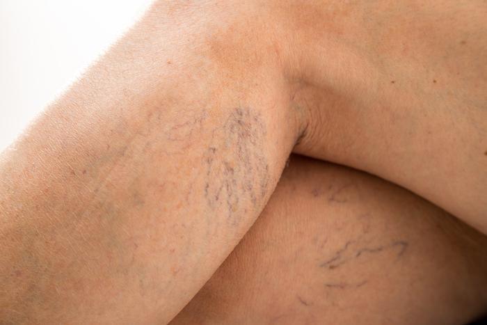 Spider Vein, Varicose Vein, Summer