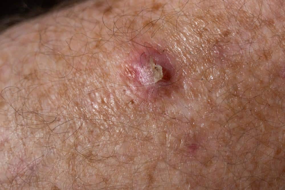 How Dangerous Is a Squamous Cell Carcinoma?