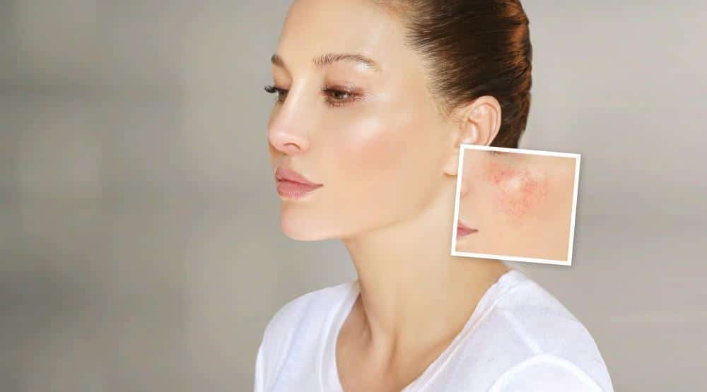 Is There a Solution for Rosacea?