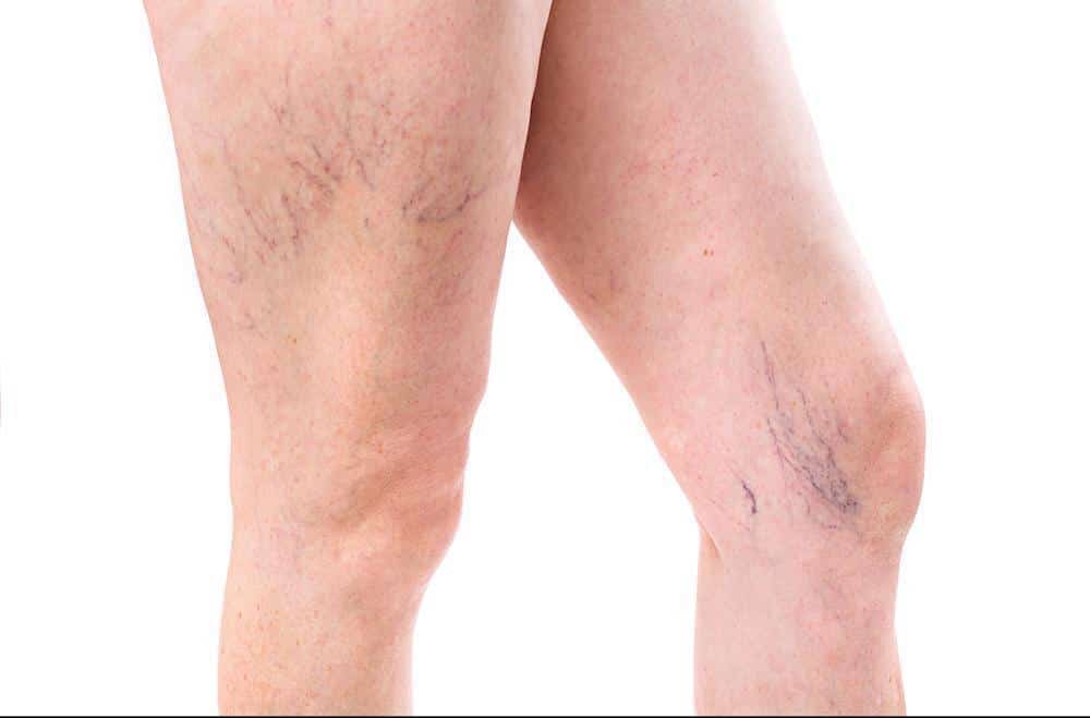 What Spider Veins Say About Your Health: Manhattan Dermatology