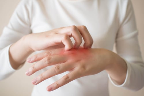 Young,Woman,Scratching,The,Itch,On,Her,Hands,W/,Redness