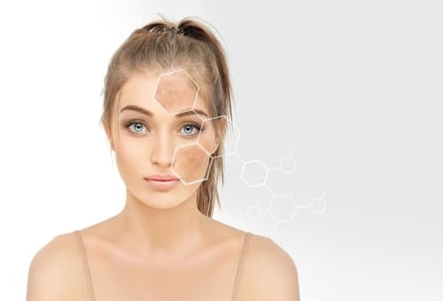 Dark,Spots,,Freckles,hyperpigmentation(melasma,Or,Chloasma),concept,-,Skin,Lightening,,Skin,Whitening,