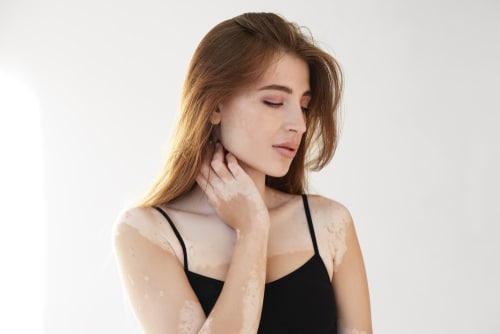 Image,Of,Beautiful,Young,Woman,Having,White,Vitiligo,Spots,On