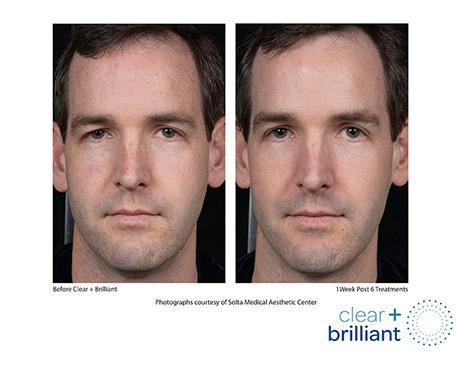 Before and After Image: Clear+Brilliant® - front