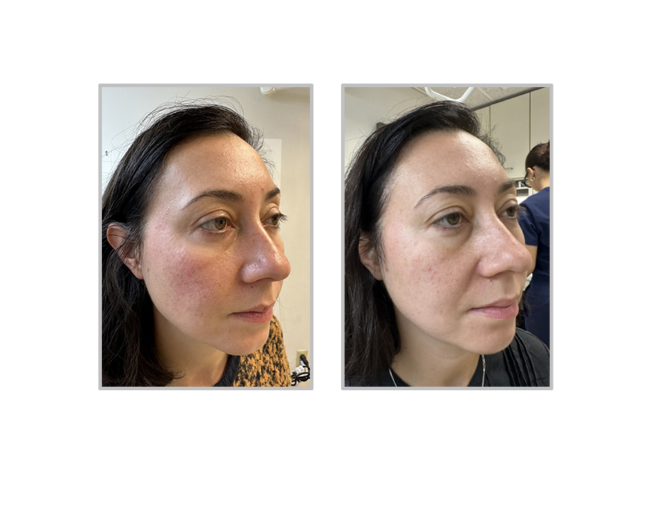 Before and After Image: Excel V+ Laser (Rosacea on the face) - right-front-oblique