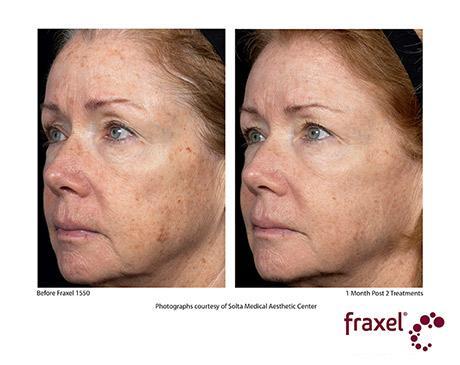 Before and After Image: Fraxel Dual - left-front-oblique