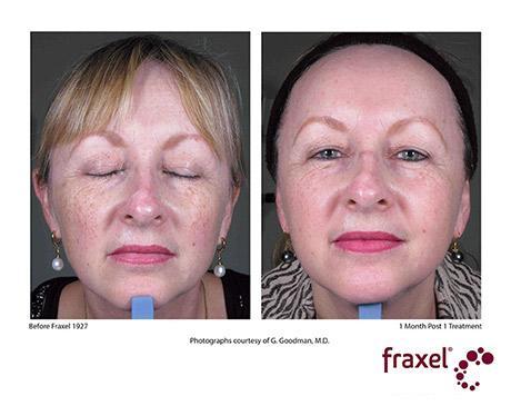 Before and After Image: Fraxel Dual - front