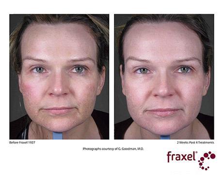 Before and After Image: Fraxel Dual - front
