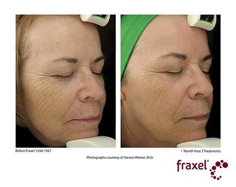 Before and After Image: Fraxel Dual - right-front-oblique