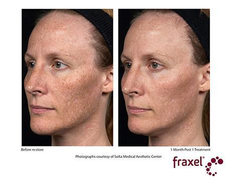 Before and After Image: Fraxel Dual - left-front-oblique