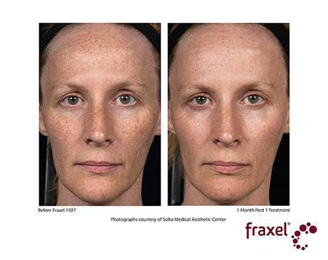 Before and After Image: Fraxel Dual - front
