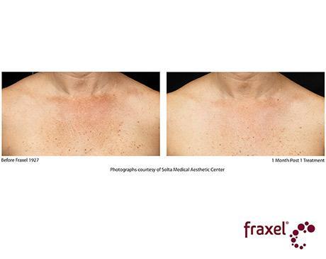 Before and After Image: Fraxel Dual - front