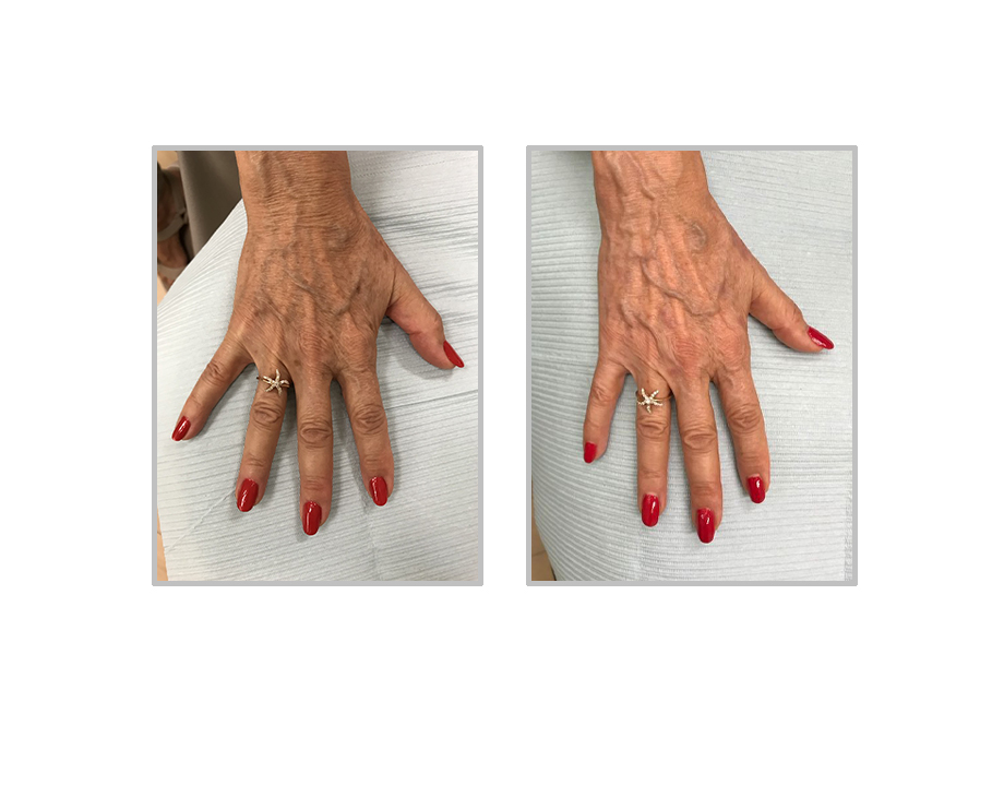Before and After Image: Ruby Laser - front