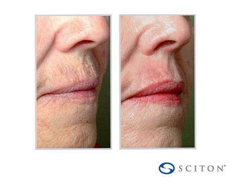 Before and After Image: Sciton Contour TRL - right-front-oblique