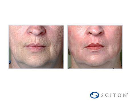 Before and After Image: Sciton Contour TRL - front