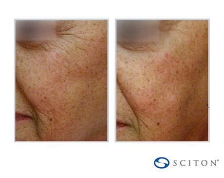 Before and After Image: Sciton Contour TRL - left-front-oblique