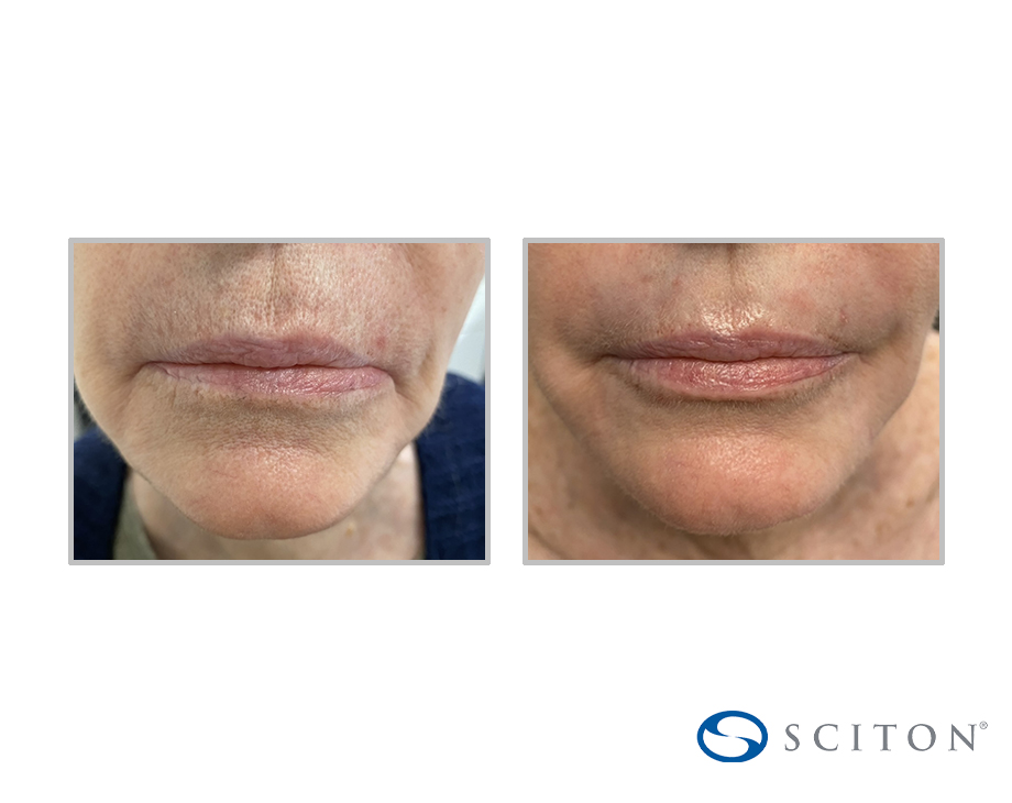Before and After Image: Sciton Contour TRL® - front