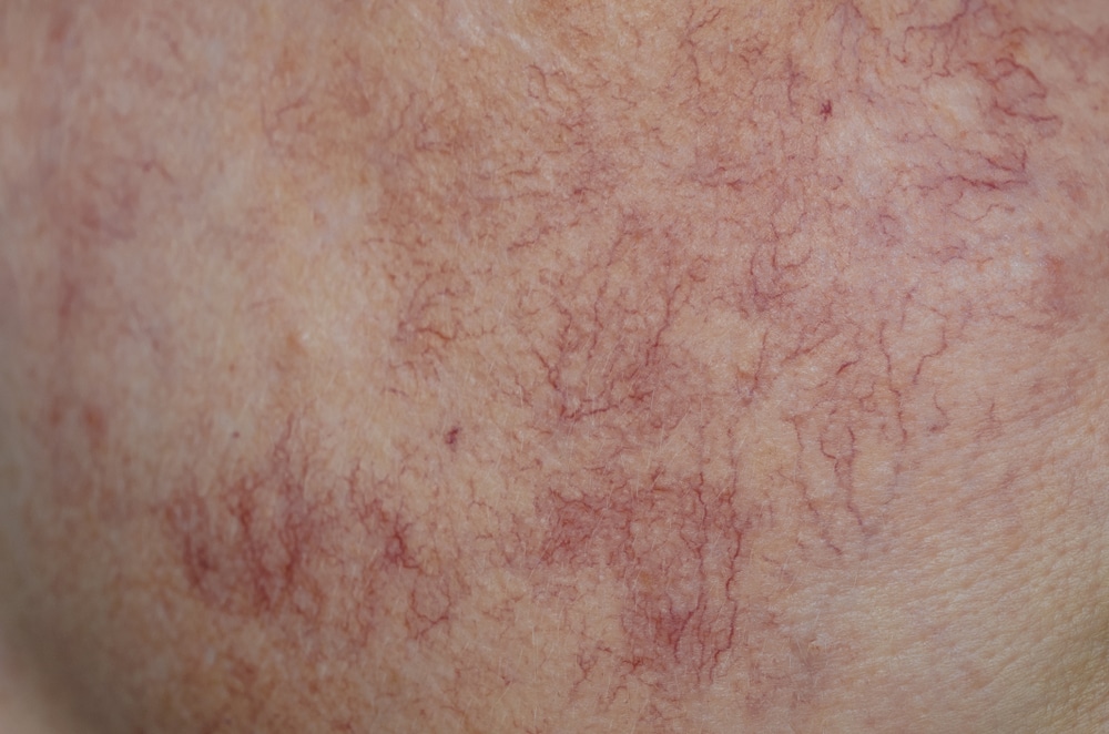 Close-up image of facial spider veins on person's cheek