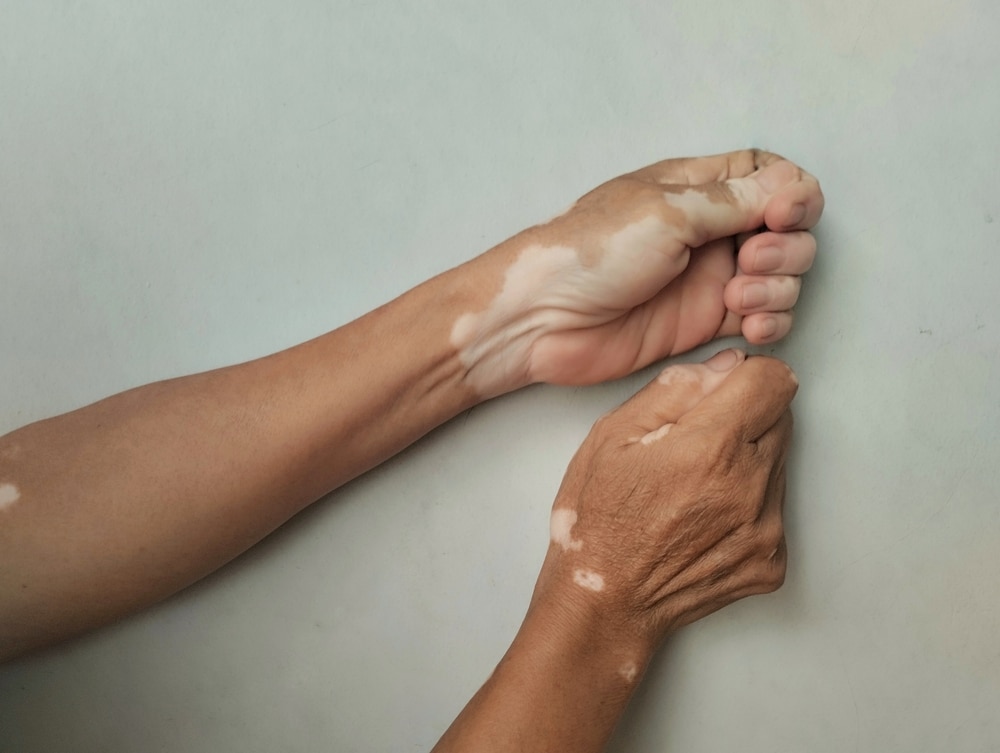 Hands with visible white patches from vitiligo-related pigment loss.