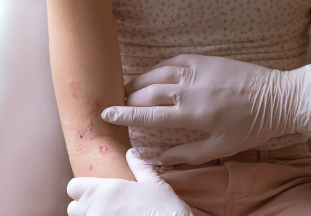 Dermatologist examining a red, dry, irritated rash on a patient’s inner elbow.