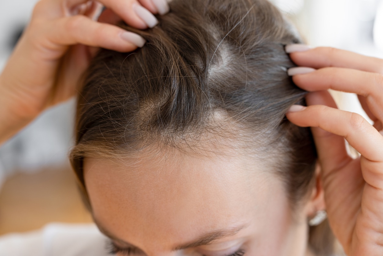 Woman parting her hair to show visible thinning along the hairline and scalp.