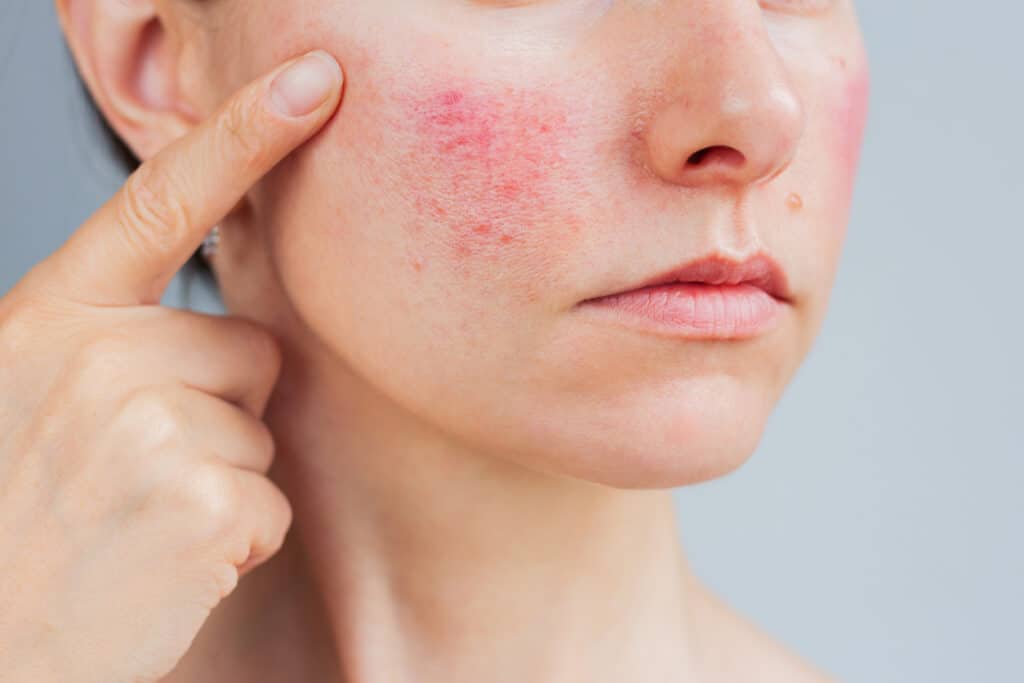 Woman pointing to persistent redness and small bumps on her cheek associated with rosacea or acne.